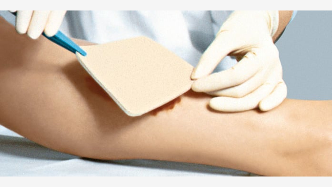 Due to the special pore structure PerrmaFoam takes up detritus as well as slough and viscous exudate from the wound and enables a fast and effectivfe wound cleansing.