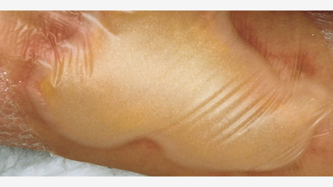 Hydrocoll, Hydroactive wound dressings