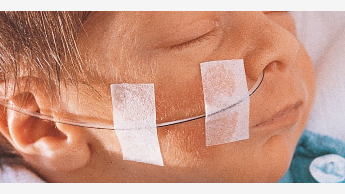 For a particularly gentle fixation, the extremely permeable to air and water vapour Omnipor® is used.