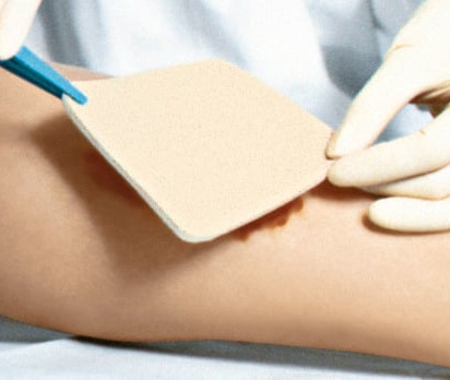 Due to the special pore structure PerrmaFoam takes up detritus as well as slough and viscous exudate from the wound and enables a fast and effectivfe wound cleansing.