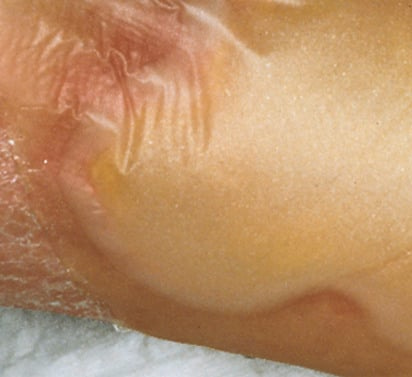 Hydrocoll, Hydroactive wound dressings