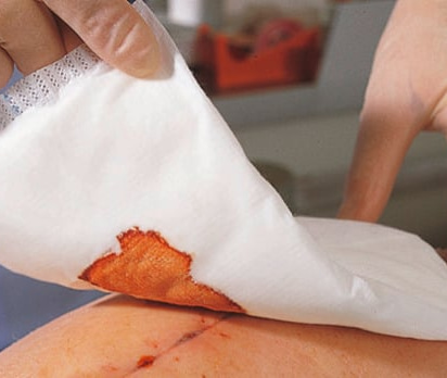 Zetuvit absorbent pad in use