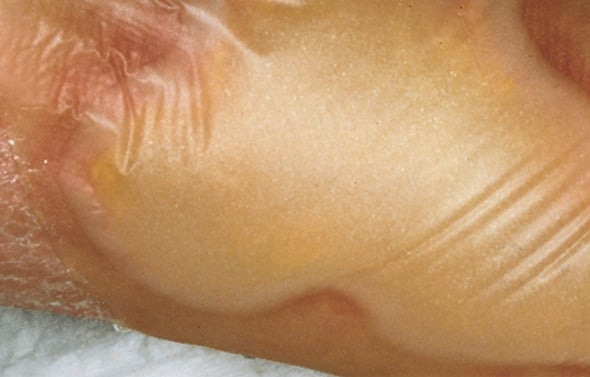 Hydrocoll, Hydroactive wound dressings