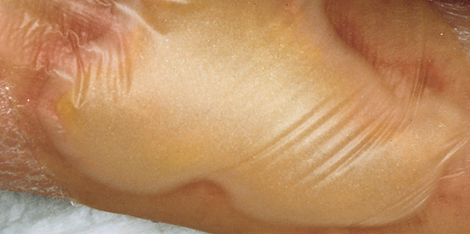 Hydrocoll, Hydroactive wound dressings